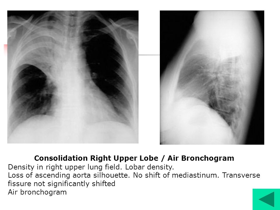 Consolidation Right Upper Lobe / Air Bronchogram Density in right upper lung field.