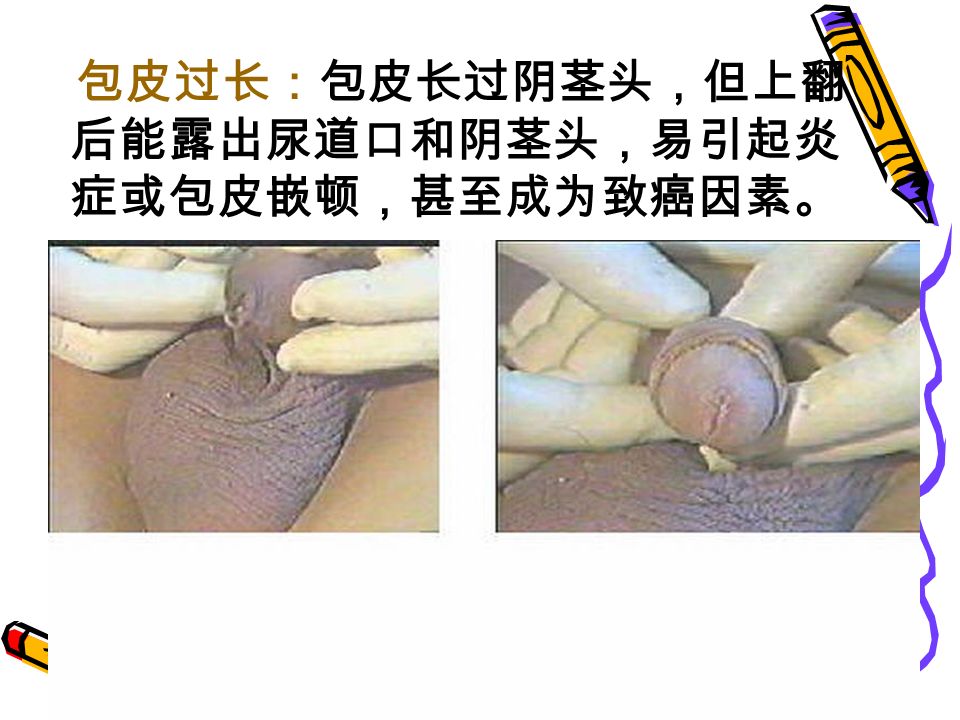 （ 二）检查内容： 1 、阴茎 分、头、体尾三部分，成人长约 7 ～ 10cm ，由 3 个海绵体构成，富于弹性、伸展 性，充血后可以勃起。 ⑴包皮 阴茎皮肤在阴茎颈前向内翻转覆盖于表面称 为包皮。成人阴茎松弛时，包皮不应掩盖尿道 口，翻起后应露出阴茎头，若不能翻起露出外 尿道口或阴茎头称为包茎，见于先天性包皮口 狭窄或炎症、外伤后粘连。