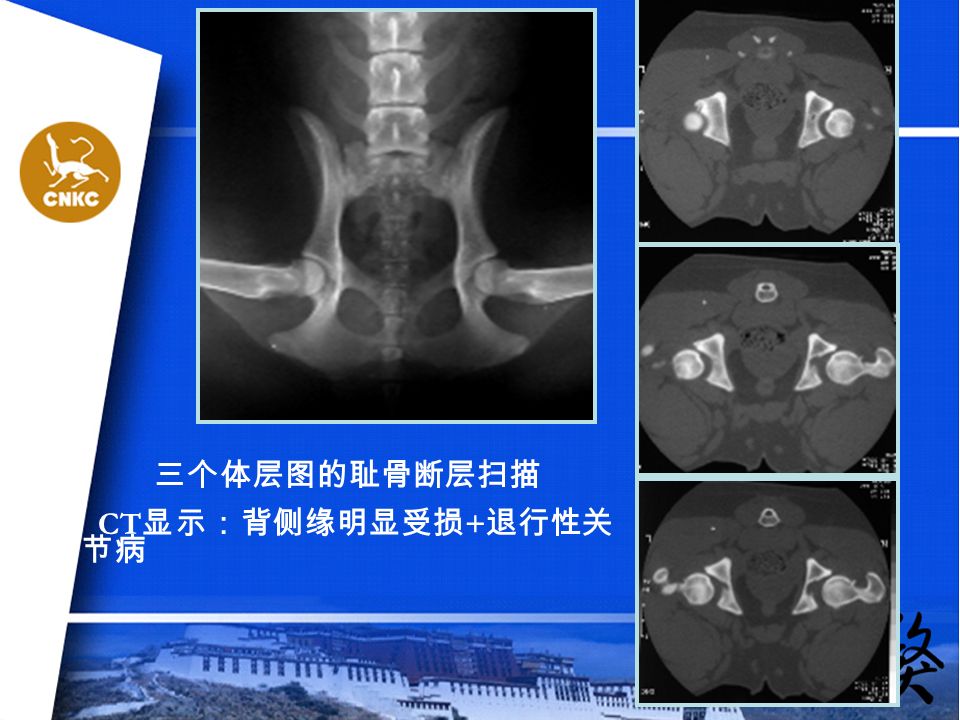 三个体层图的耻骨断层扫描 CT 显示：背侧缘明显受损 + 退行性关 节病