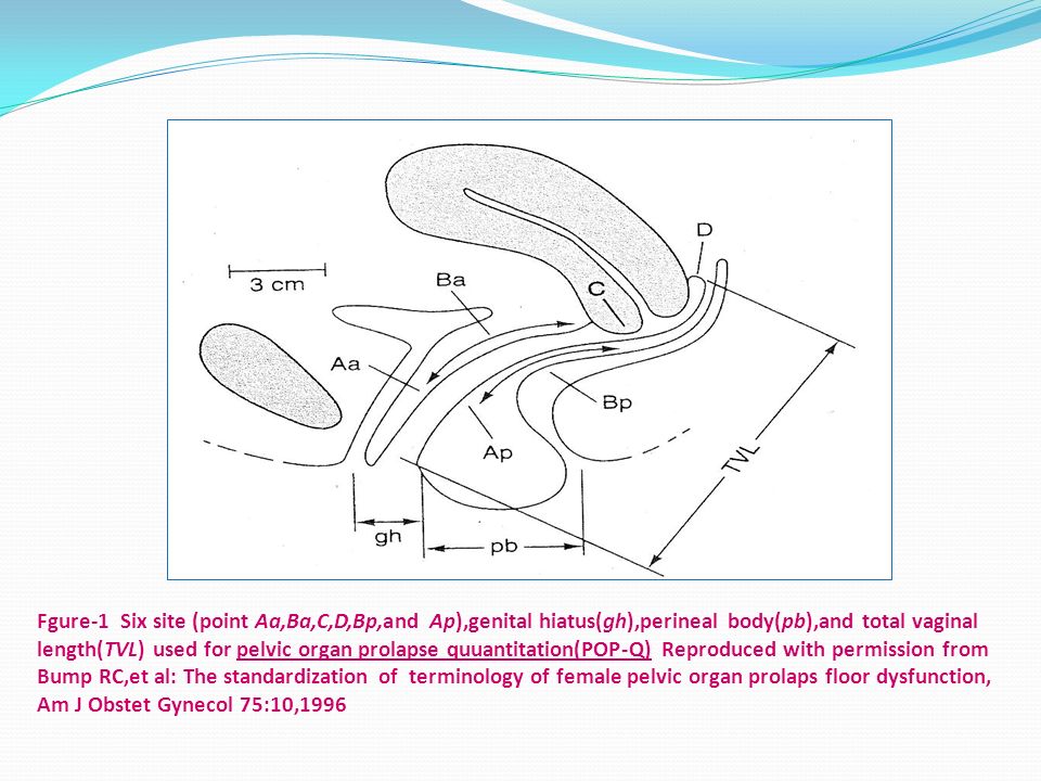 Fgure-1 Six site (point Aa,Ba,C,D,Bp,and Ap),genital hiatus(gh),perineal body(pb),and total vaginal length(TVL) used for pelvic organ prolapse quuantitation(POP-Q) Reproduced with permission from Bump RC,et al: The standardization of terminology of female pelvic organ prolaps floor dysfunction, Am J Obstet Gynecol 75:10,1996