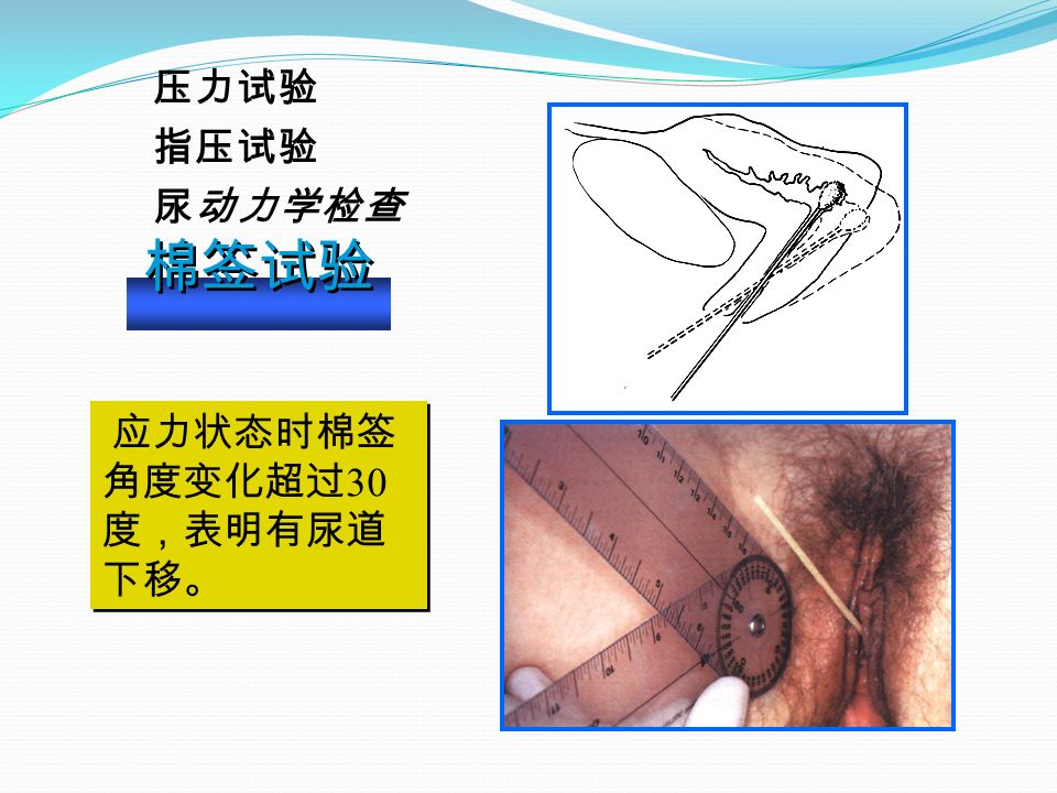 棉签试验 应力状态时棉签 角度变化超过 30 度，表明有尿道 下移。 压力试验 指压试验 尿动力学检查