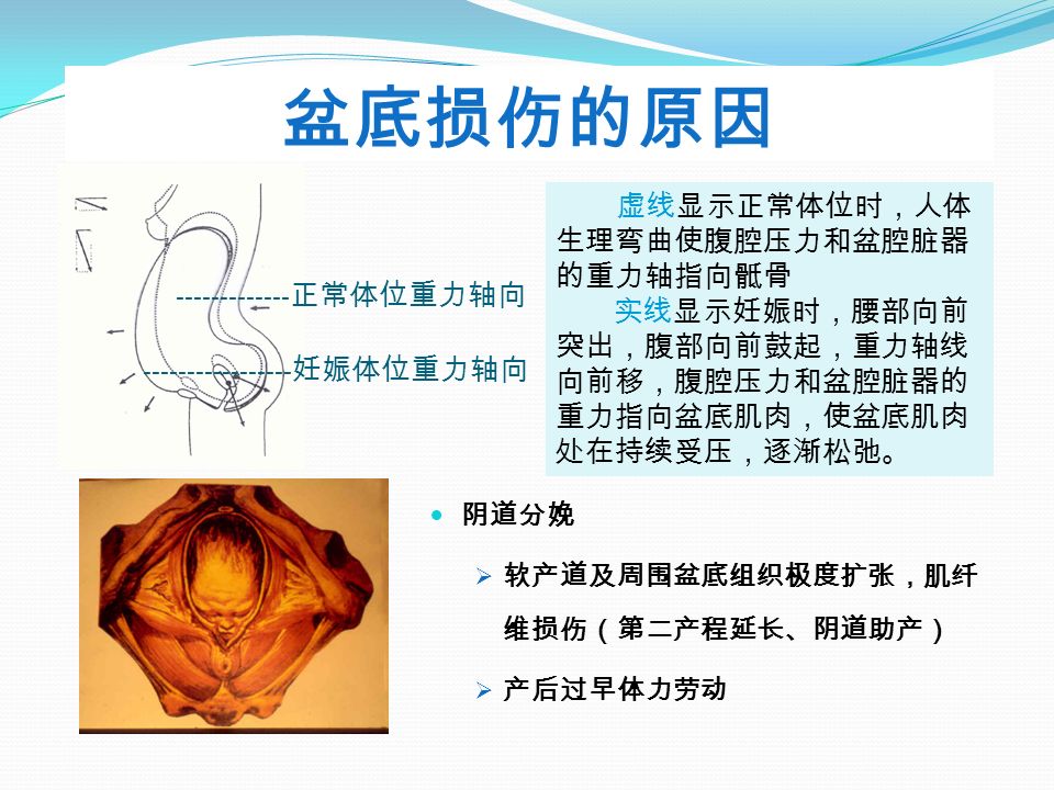 盆底损伤的原因 阴道分娩  软产道及周围盆底组织极度扩张，肌纤 维损伤（第二产程延长、阴道助产）  产后过早体力劳动 虚线显示正常体位时，人体 生理弯曲使腹腔压力和盆腔脏器 的重力轴指向骶骨 实线显示妊娠时，腰部向前 突出，腹部向前鼓起，重力轴线 向前移，腹腔压力和盆腔脏器的 重力指向盆底肌肉，使盆底肌肉 处在持续受压，逐渐松弛。 正常体位重力轴向 妊娠体位重力轴向