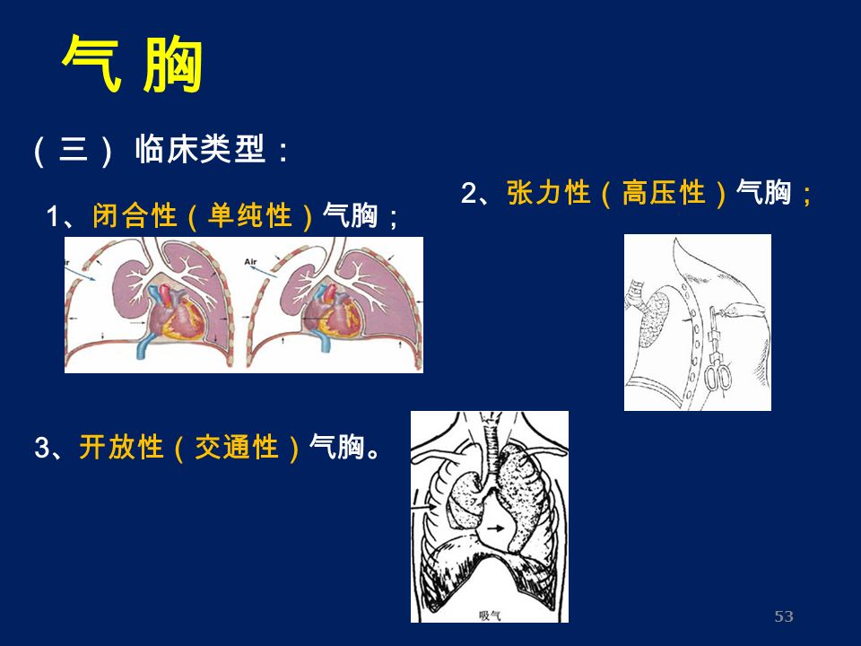 53 （三） 临床类型： 1 、闭合性（单纯性）气胸； 2 、张力性（高压性）气胸； 3 、开放性（交通性）气胸。 气 胸气 胸