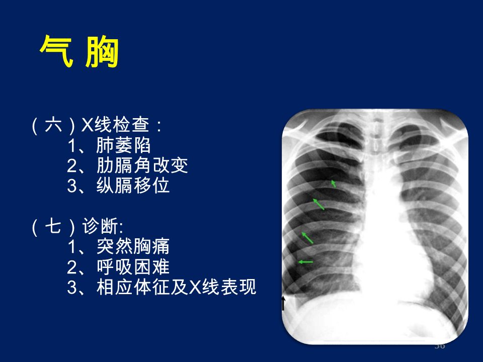 56 （六） X 线检查： 1 、肺萎陷 2 、肋膈角改变 3 、纵膈移位 （七）诊断 : 1 、突然胸痛 2 、呼吸困难 3 、相应体征及 X 线表现 气 胸气 胸