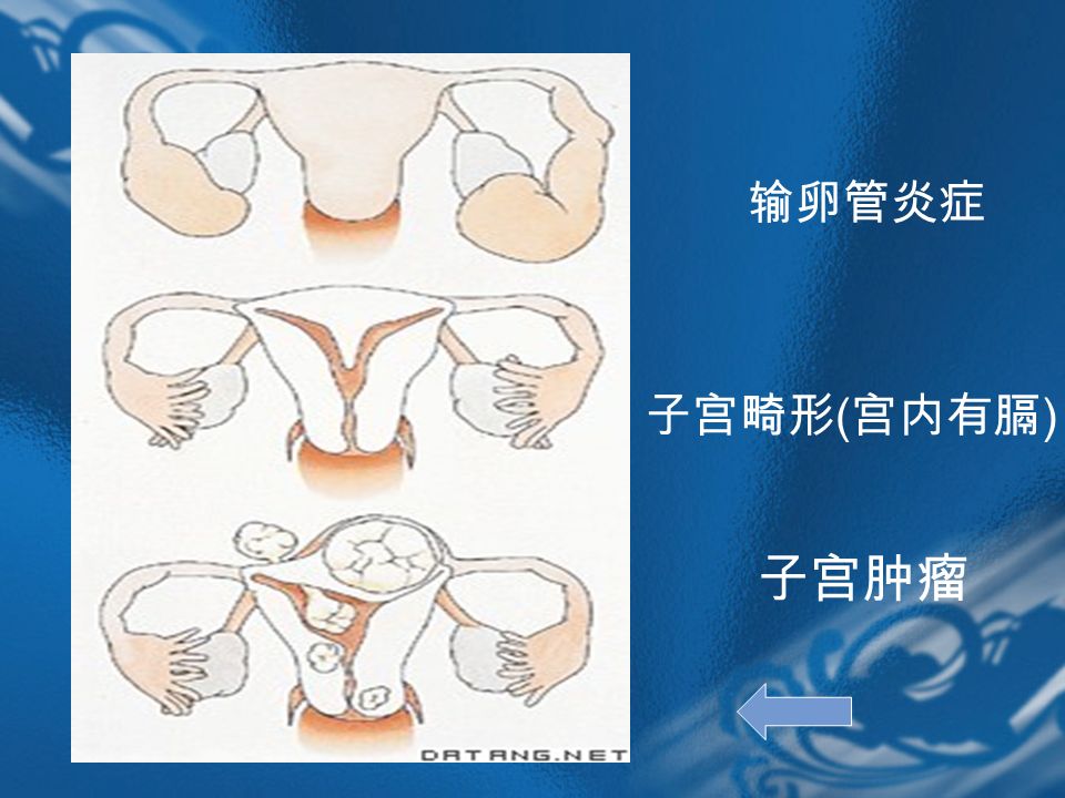 子宫肿瘤 输卵管炎症 子宫畸形 ( 宫内有膈 )
