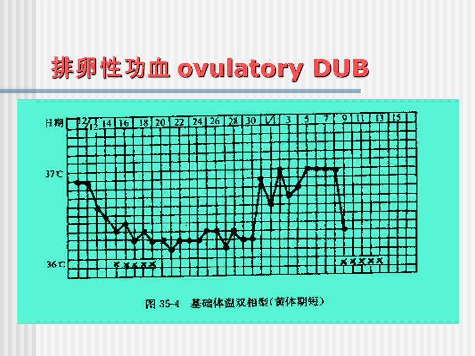 排卵性功血 ovulatory DUB