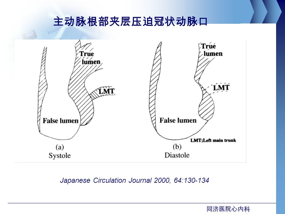 同济医院心内科 主动脉根部夹层压迫冠状动脉口 Japanese Circulation Journal 2000, 64: