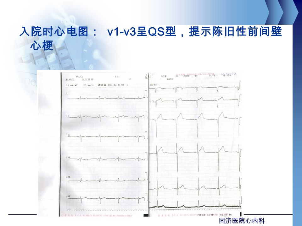 同济医院心内科 入院时心电图： v1-v3 呈 QS 型，提示陈旧性前间壁 心梗