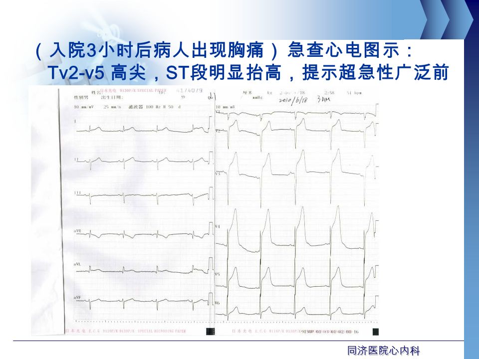 同济医院心内科 （入院 3 小时后病人出现胸痛） 急查心电图示： Tv2-v5 高尖， ST 段明显抬高，提示超急性广泛前 壁心梗