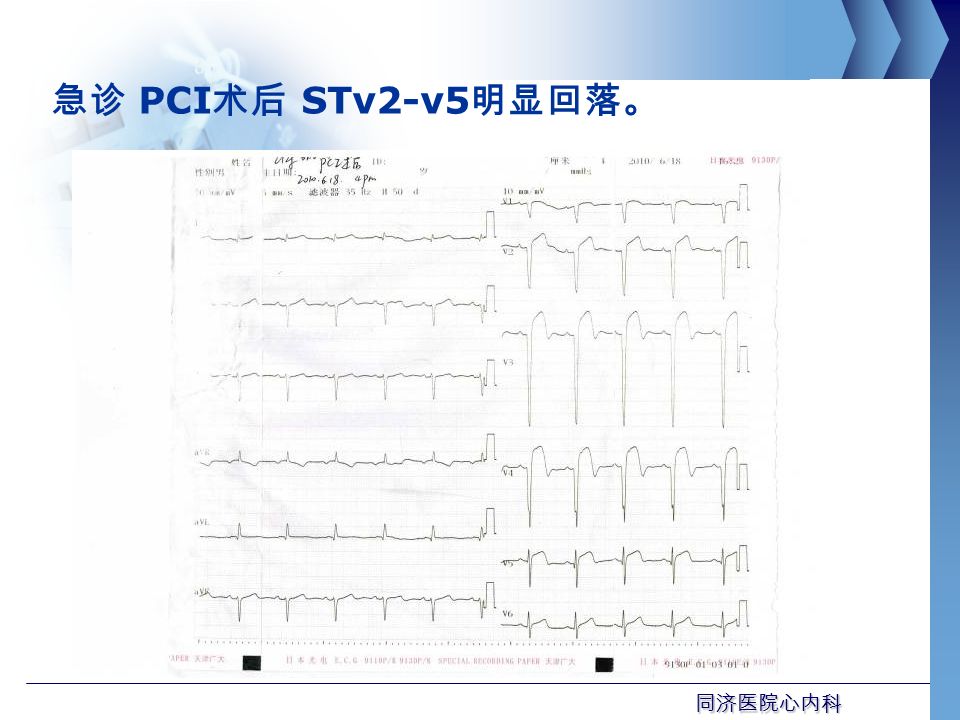 同济医院心内科 急诊 PCI 术后 STv2-v5 明显回落。
