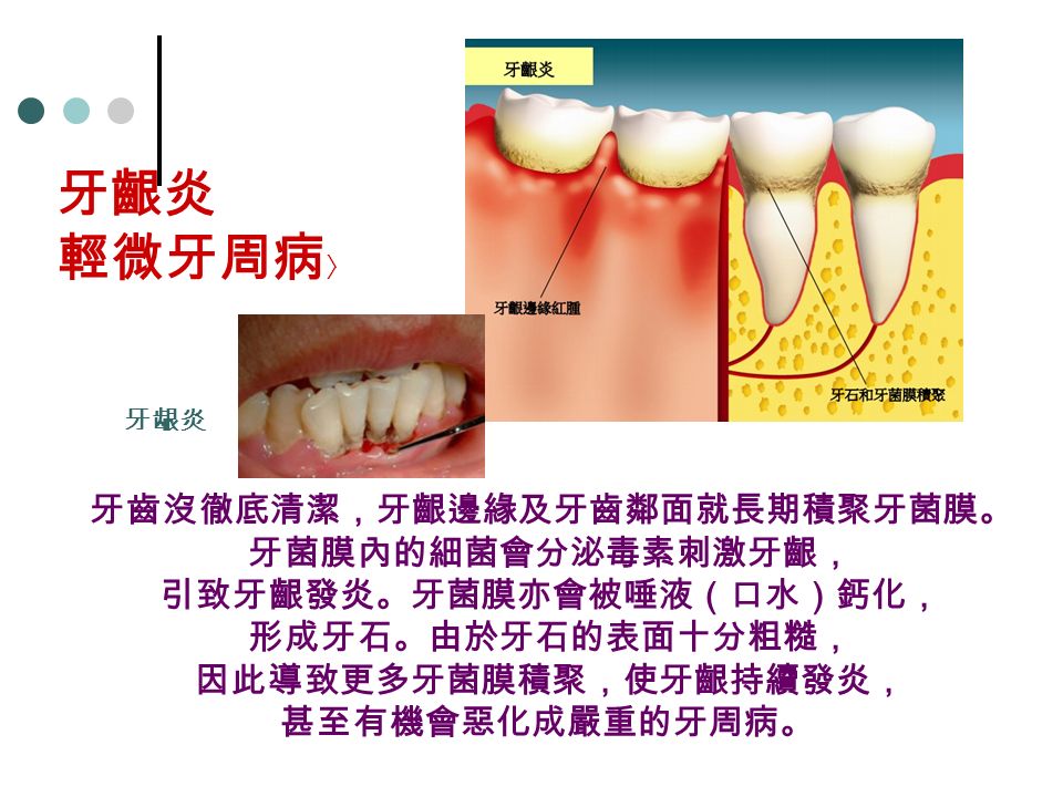 牙齒沒徹底清潔，牙齦邊緣及牙齒鄰面就長期積聚牙菌膜。 牙菌膜內的細菌會分泌毒素刺激牙齦， 引致牙齦發炎。牙菌膜亦會被唾液（口水）鈣化， 形成牙石。由於牙石的表面十分粗糙， 因此導致更多牙菌膜積聚，使牙齦持續發炎， 甚至有機會惡化成嚴重的牙周病。 牙龈炎 牙齦炎 輕微牙周病 〉