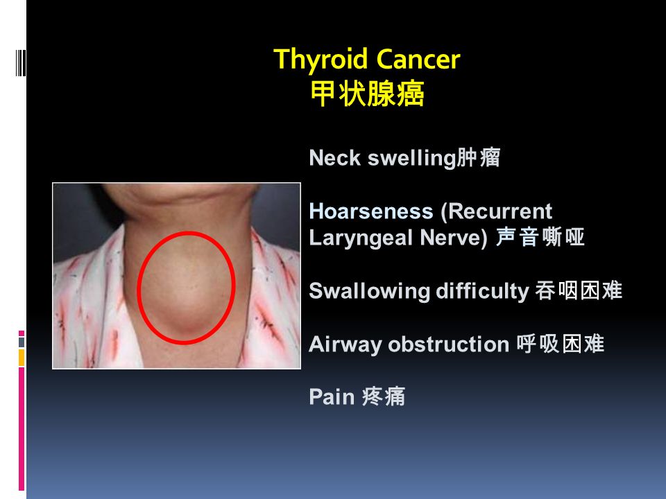 Thyroid Cancer 甲状腺癌 Neck swelling 肿瘤 Hoarseness (Recurrent Laryngeal Nerve) 声音嘶哑 Swallowing difficulty 吞咽困难 Airway obstruction 呼吸困难 Pain 疼痛