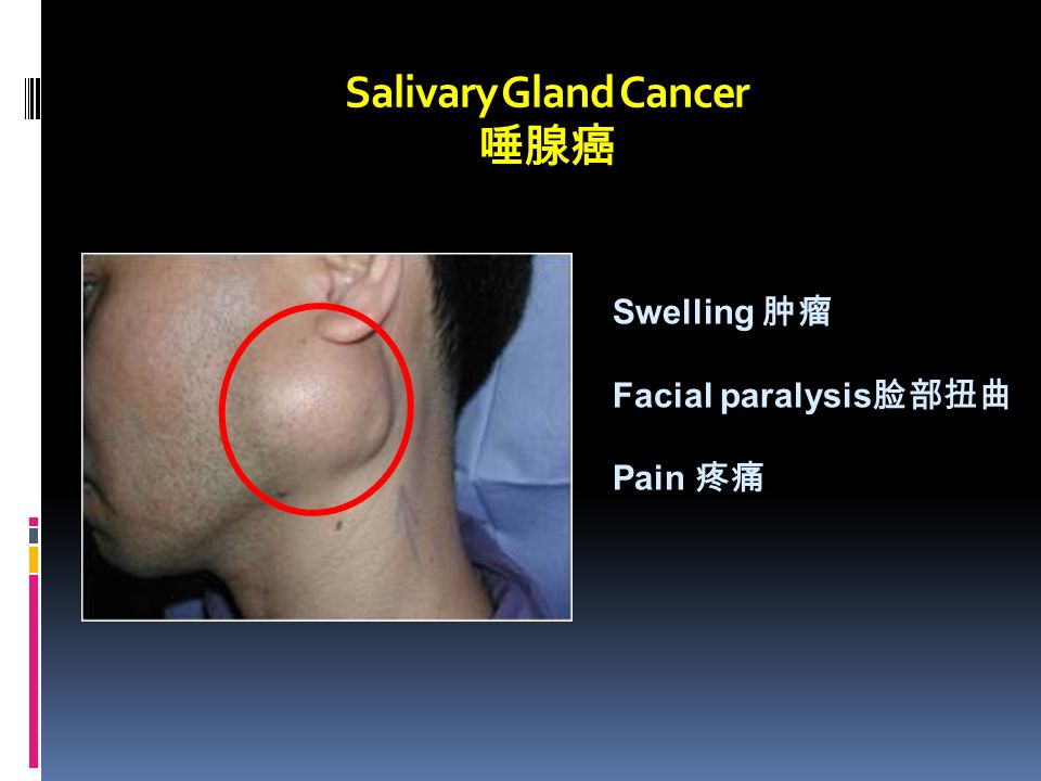 Salivary Gland Cancer 唾腺癌 Swelling 肿瘤 Facial paralysis 脸部扭曲 Pain 疼痛