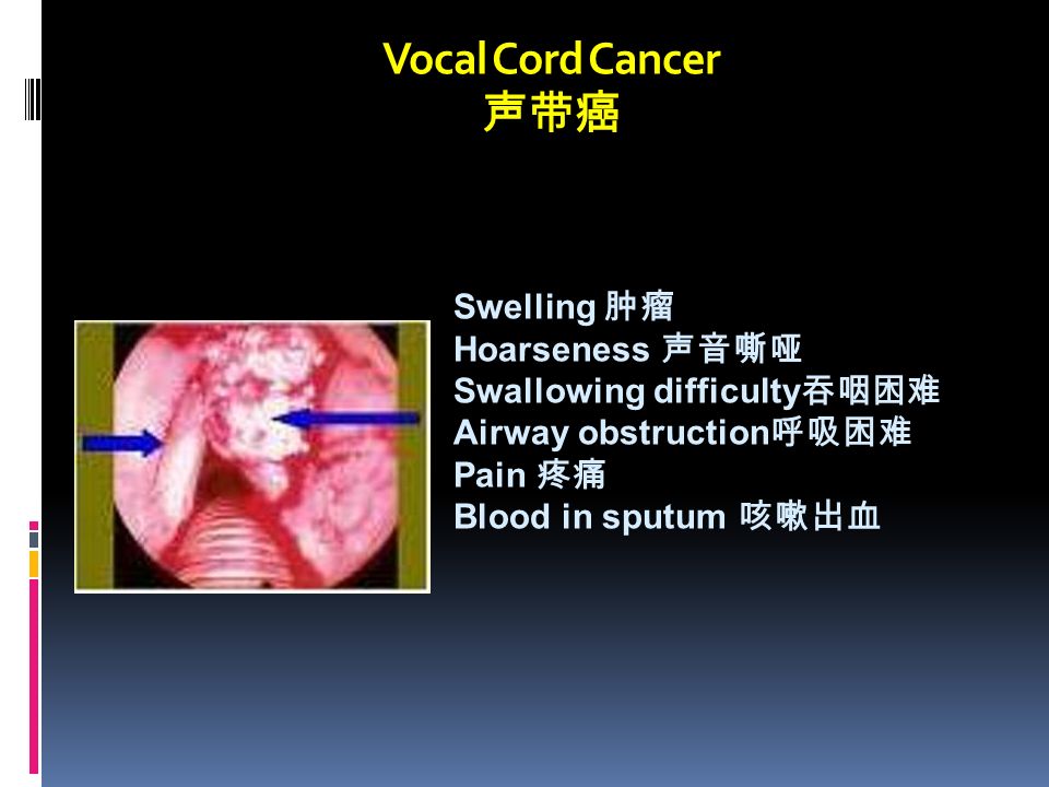 Vocal Cord Cancer 声带癌 Swelling 肿瘤 Hoarseness 声音嘶哑 Swallowing difficulty 吞咽困难 Airway obstruction 呼吸困难 Pain 疼痛 Blood in sputum 咳嗽出血