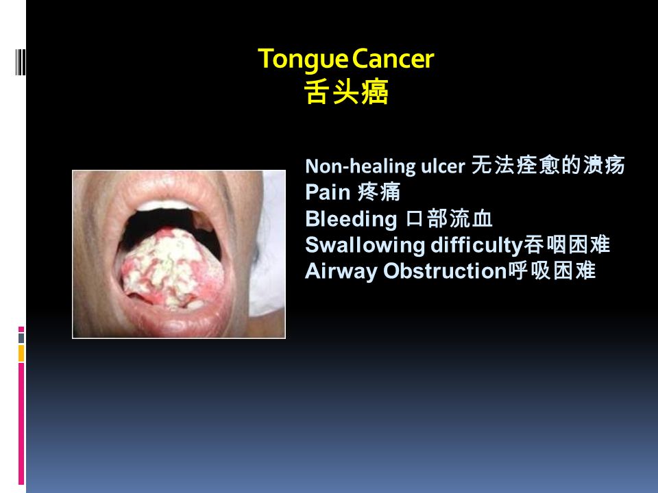 Tongue Cancer 舌头癌 Non-healing ulcer 无法痊愈的溃疡 Pain 疼痛 Bleeding 口部流血 Swallowing difficulty 吞咽困难 Airway Obstruction 呼吸困难