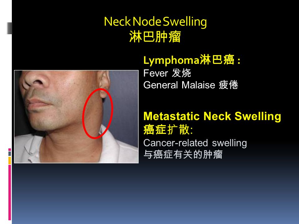 Neck Node Swelling 淋巴肿瘤 Lymphoma 淋巴癌 : Fever 发烧 General Malaise 疲倦 Metastatic Neck Swelling 癌症扩散 : Cancer-related swelling 与癌症有关的肿瘤