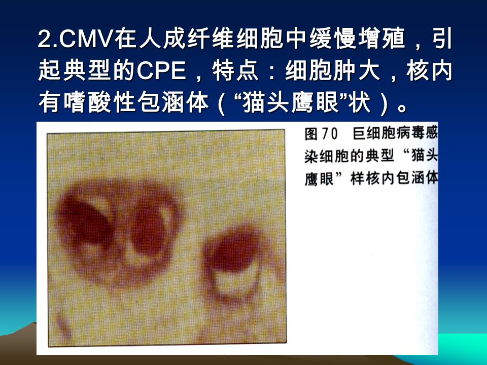 2.CMV 在人成纤维细胞中缓慢增殖，引 起典型的 CPE ，特点：细胞肿大，核内 有嗜酸性包涵体（ 猫头鹰眼 状）。