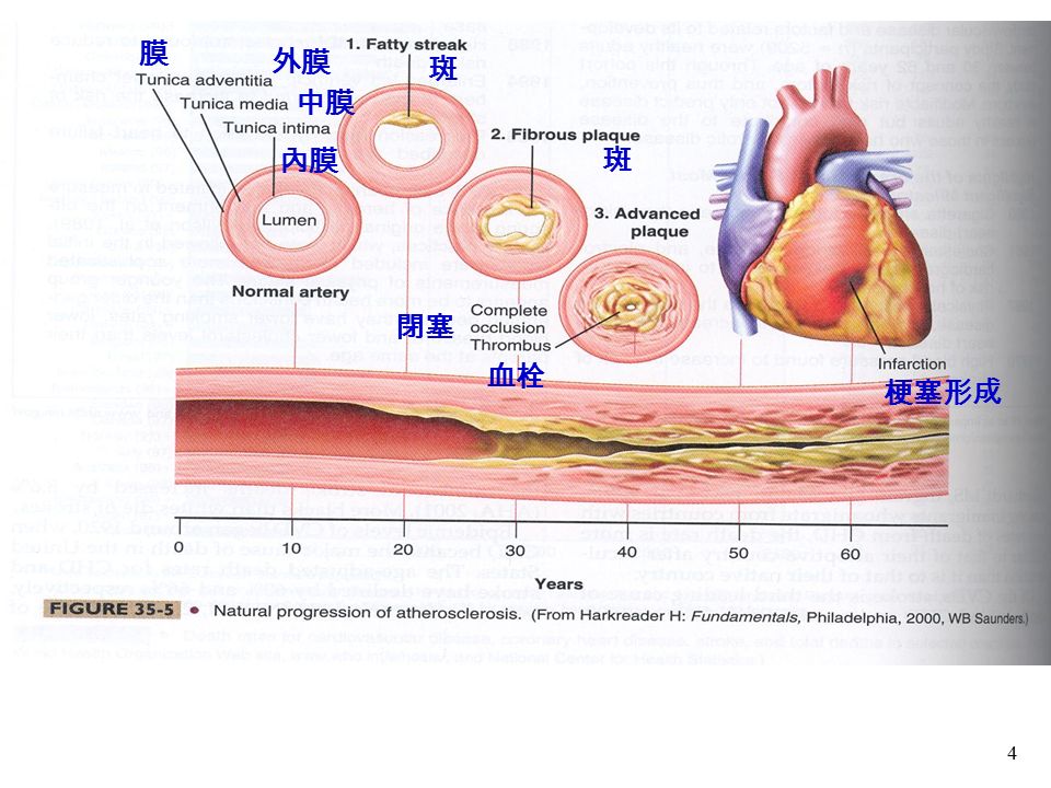 4 閉塞 血栓 斑 梗塞形成 斑 膜 外膜 中膜 內膜