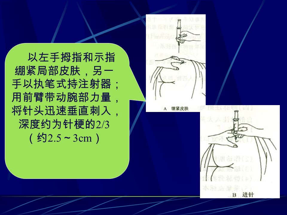 以左手拇指和示指 绷紧局部皮肤，另一 手以执笔式持注射器； 用前臂带动腕部力量， 将针头迅速垂直刺入， 深度约为针梗的 2/3 （约 2.5 ～ 3cm ）