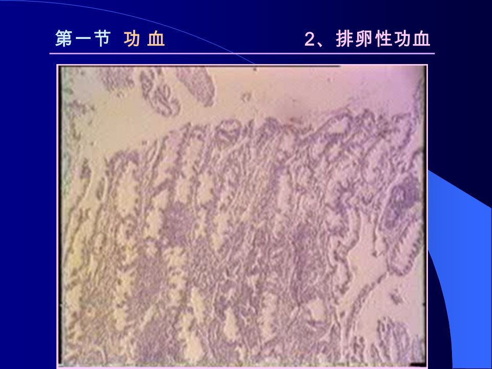 第一节 功 血 2 、排卵性功血 分 泌 期 内 膜分 泌 期 内 膜