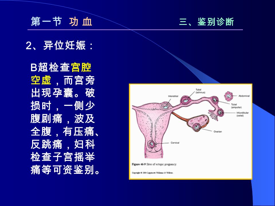 第一节 功 血 三、鉴别诊断 B 超检查宫腔 空虚，而宫旁 出现孕囊。破 损时，一侧少 腹剧痛，波及 全腹，有压痛、 反跳痛，妇科 检查子宫摇举 痛等可资鉴别。 2 、异位妊娠：