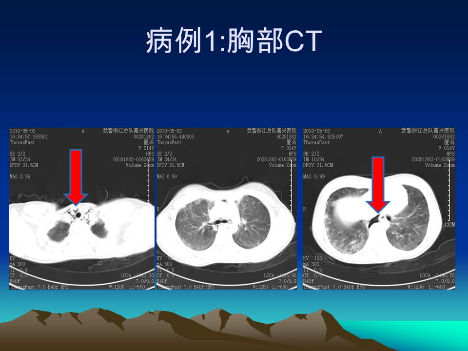 病例 1: 胸部 CT