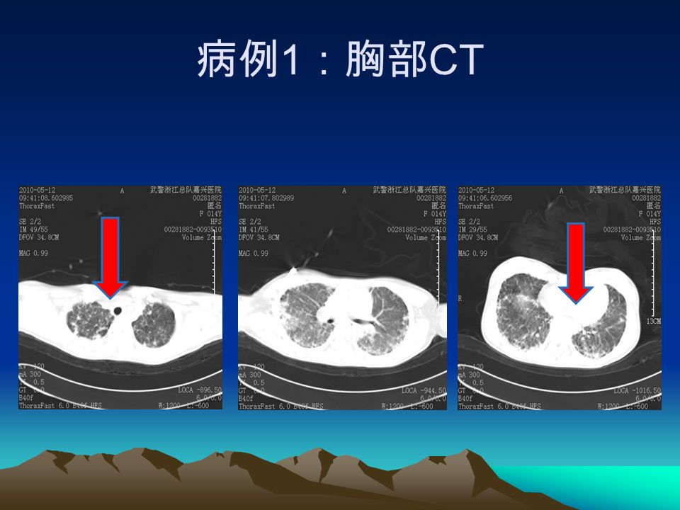 病例 1 ：胸部 CT