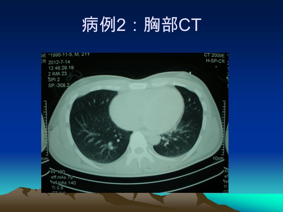 病例 2 ：胸部 CT