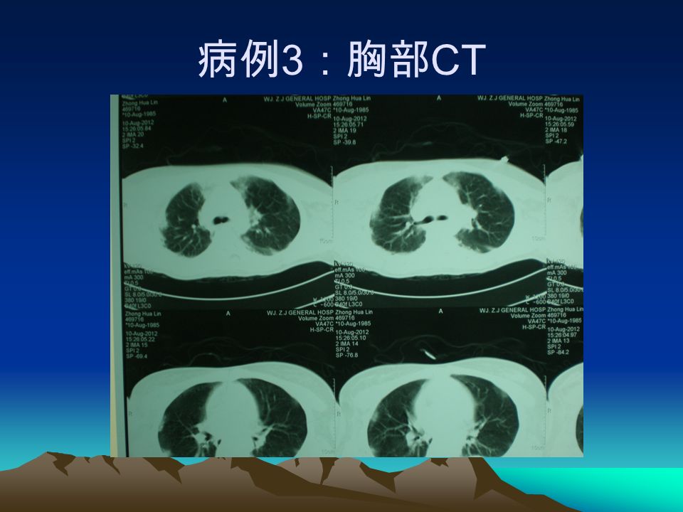 病例 3 ：胸部 CT