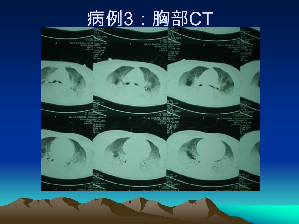 病例 3 ：胸部 CT