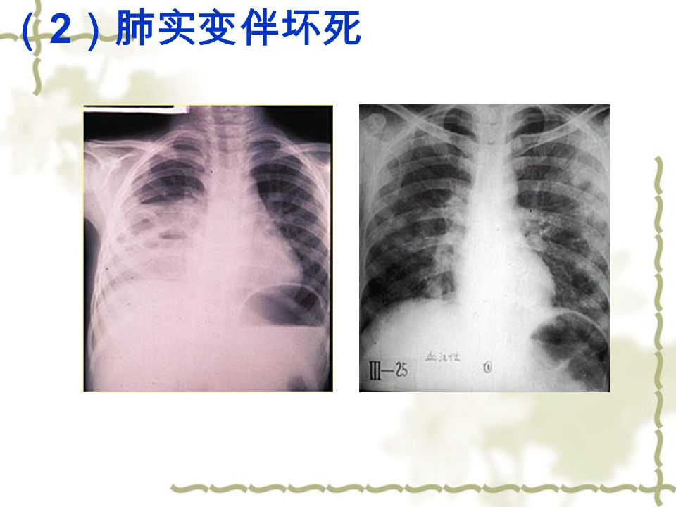 （ 2 ）肺实变伴坏死