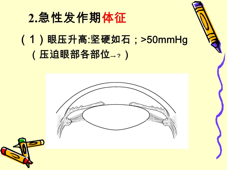 （ 1 ） 眼压升高 : 坚硬如石； >50mmHg （压迫眼部各部位 → ？ ） 2. 急性发作期体征
