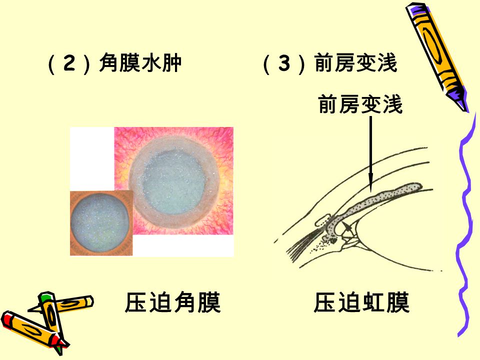 （ 2 ）角膜水肿 （ 3 ）前房变浅 压迫角膜 前房变浅 压迫虹膜