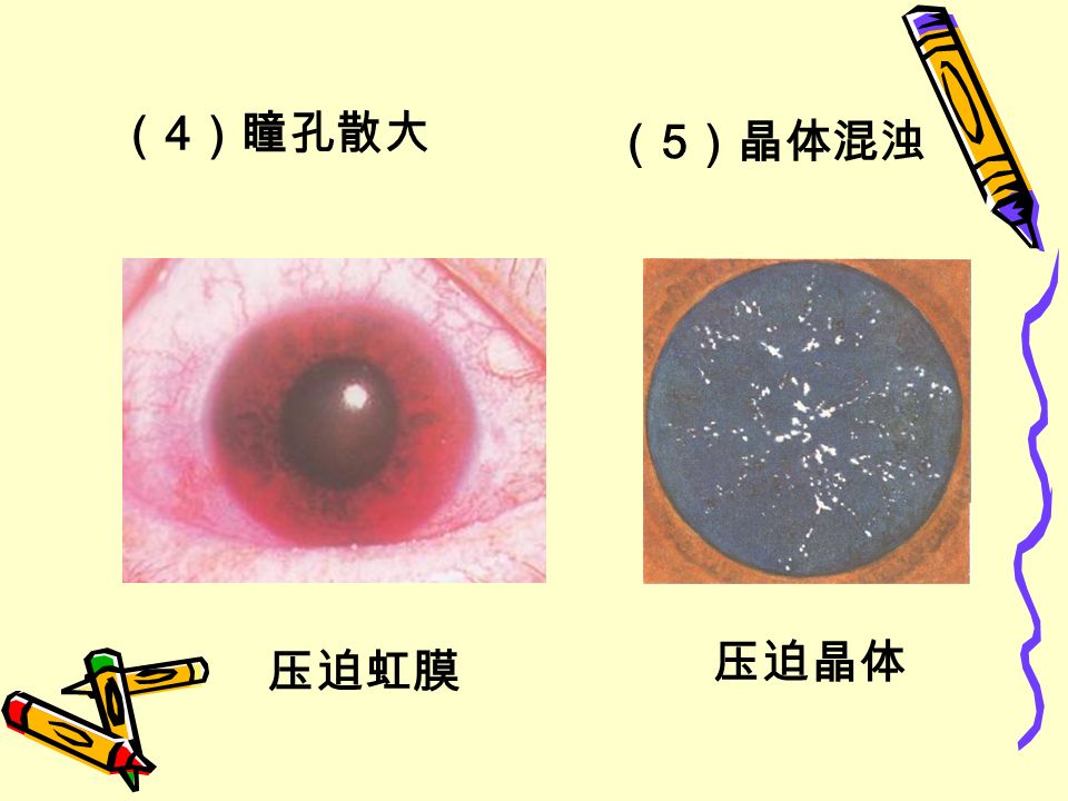 （ 4 ）瞳孔散大 （ 5 ）晶体混浊 压迫虹膜 压迫晶体