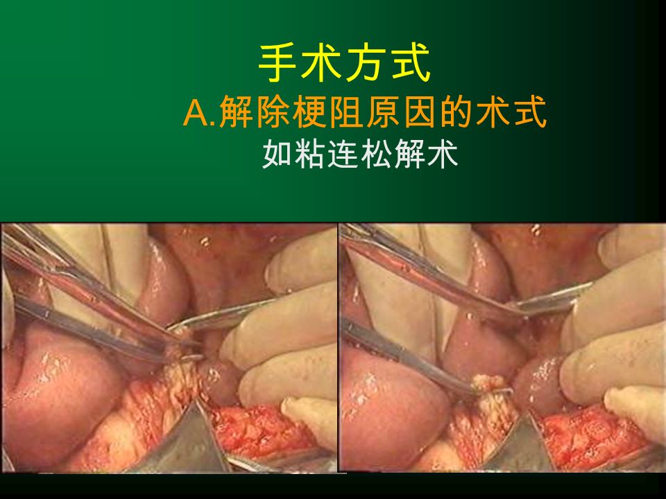 手术方式 A. 解除梗阻原因的术式 如粘连松解术