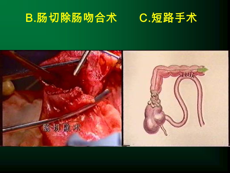 B. 肠切除肠吻合术 C. 短路手术