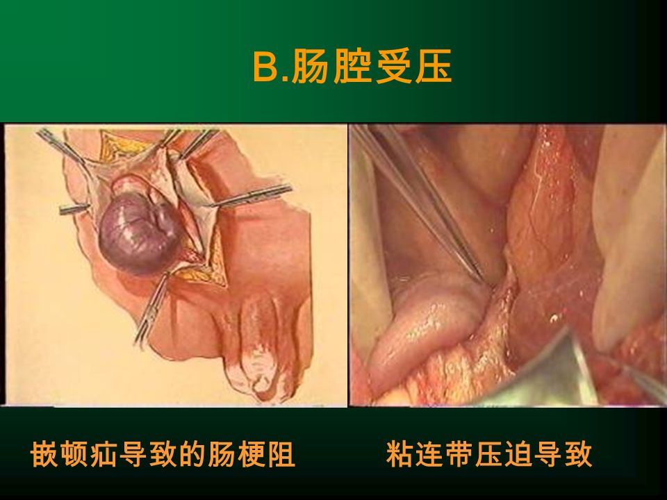 B. 肠腔受压 嵌顿疝导致的肠梗阻粘连带压迫导致