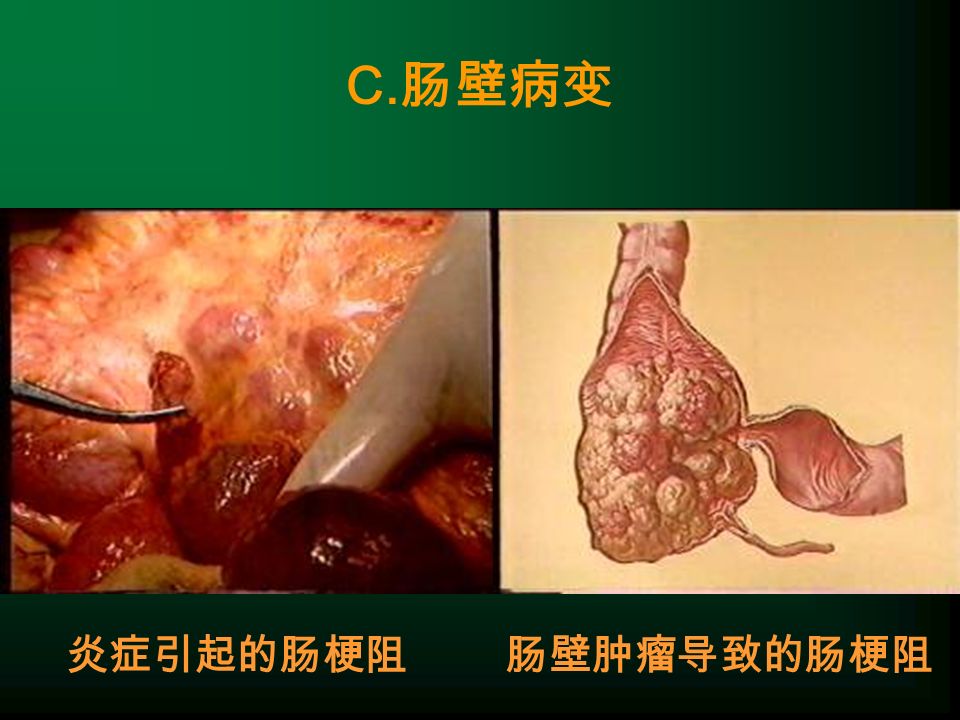 C. 肠壁病变 炎症引起的肠梗阻肠壁肿瘤导致的肠梗阻