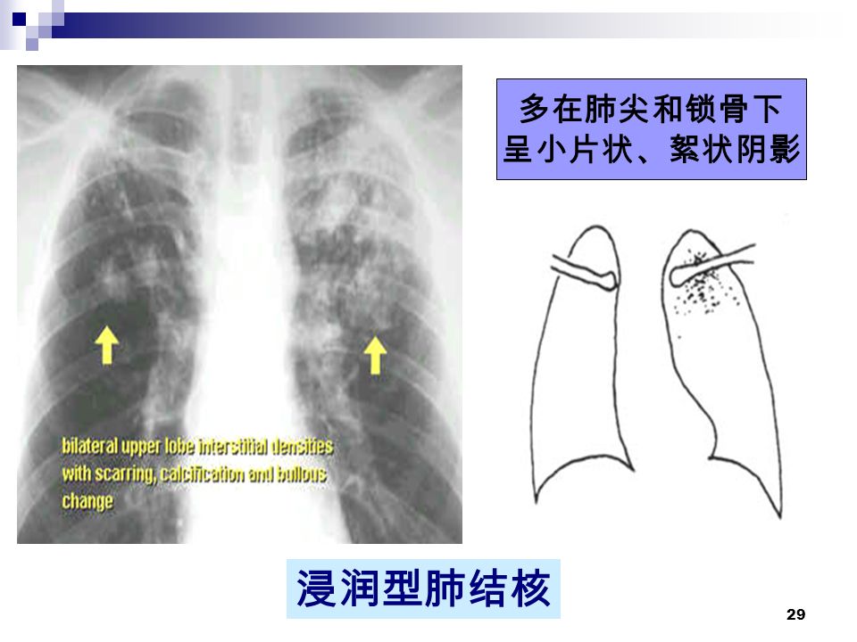 29 浸润型肺结核 多在肺尖和锁骨下 呈小片状、絮状阴影